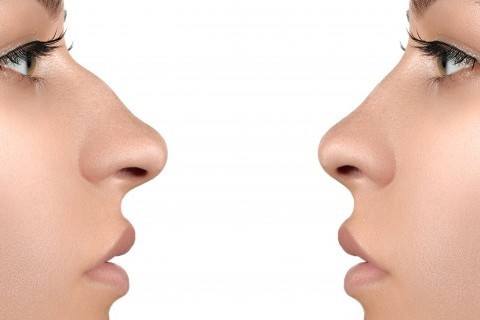 kadinlarda-burun-estetigi